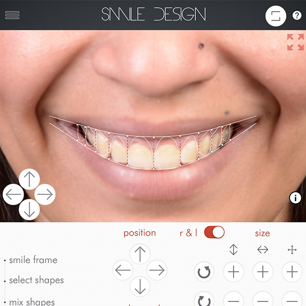 The general shape of the esthetic zone was determined.