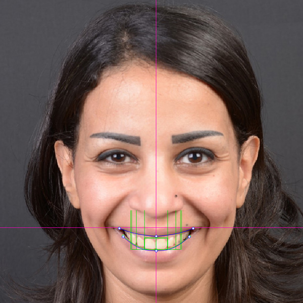 Le Digital Smile Design a été transmis dans le logiciel NemoDSD 3D.