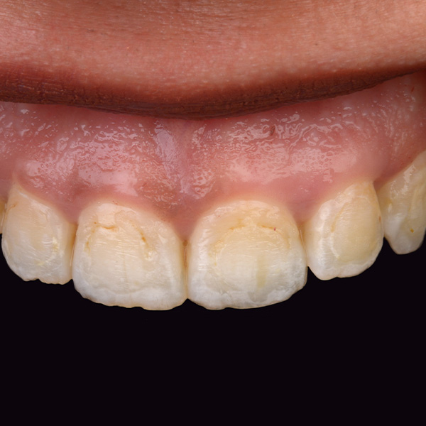 A seguito del trattamento ortodontico si erano formate macchie marrone e bianche.