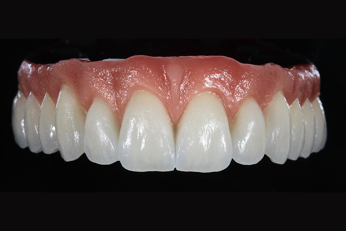 Result: With efficient layering, a highly esthetic result was achieved.