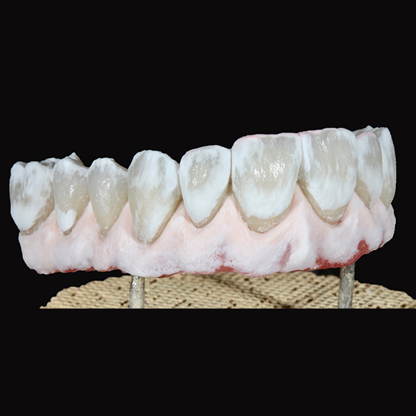 Per la cottura di correzione sono stati usati PEARL shell e nell'area gengivale GINGIVA light-rose.