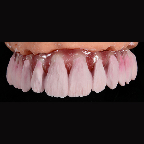 Der Dentinkern mit DENTINE A3 an den Eckzähnen und DENTINE A2 an den restlichen Zähnen.