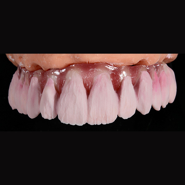 The dentine core with DENTINE A3 on the canines and DENTINE A2 on the other teeth.