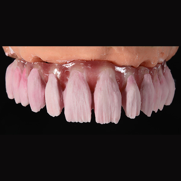 Anatomische Cut-backs wurden nach der Schichtung des Dentinkerns durchgeführt.