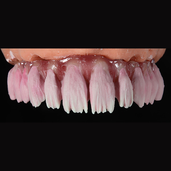 The mamelon structure of the incisors was reconstructed with MAMELON saffron.