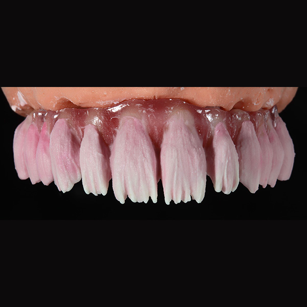 La structure de mamelon des incisives a été reconstruite avec du MAMELON saffron.