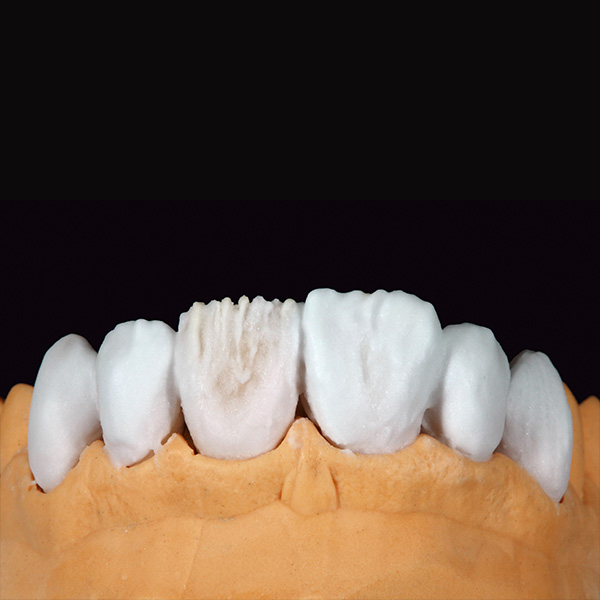 Die abschließende Formgebung der sechs Veneers erfolgte mit ENAMEL light.