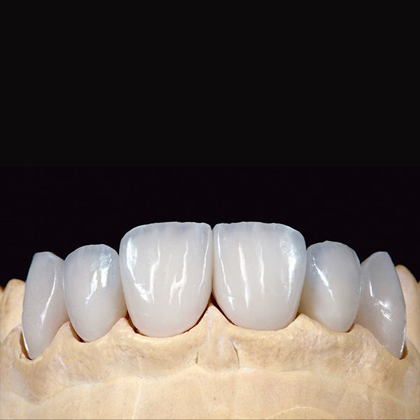 The natural-looking appearance of the six veneers was already visible in the master model.
