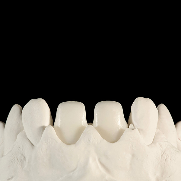 Frameworks fabricated using CAD/CAM technology: made from VITA YZ HT White zirconia.