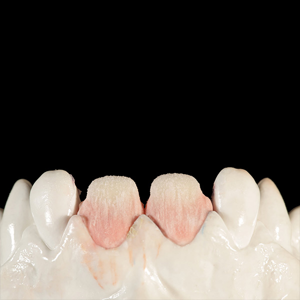 Dans le tiers cervical, on a stratifié de la DENTINE A3 plus chromatique.