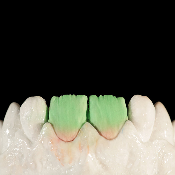 In the upper two thirds, a brighter DENTINE A1 dentin core was created.