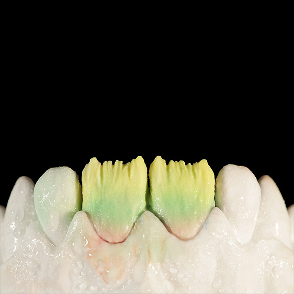 Buildup of the incisal area using a 1:1 combination of DENTINE A1 and OPAL TRANSLUCENT opal neutral.