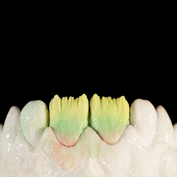 Stratificazione con una miscela uno-a-uno di DENTINE A1 e OPAL TRANSLUCENT opal neutral nell'area dello smalto.