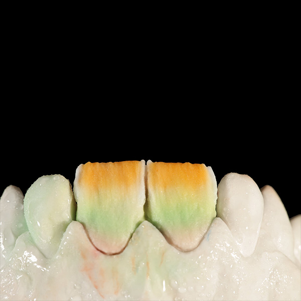 Coverage of the incisal area with a balanced combination of TRANSLUCENT foggy grey and sunlight.