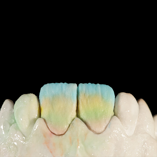 Successive buildup of the incisal area using OPAL TRANSLUCENT opal azure.