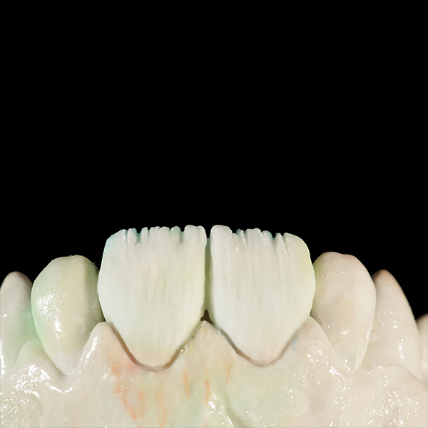 Buildup of the upper third of the incisal area using ENAMEL clear.