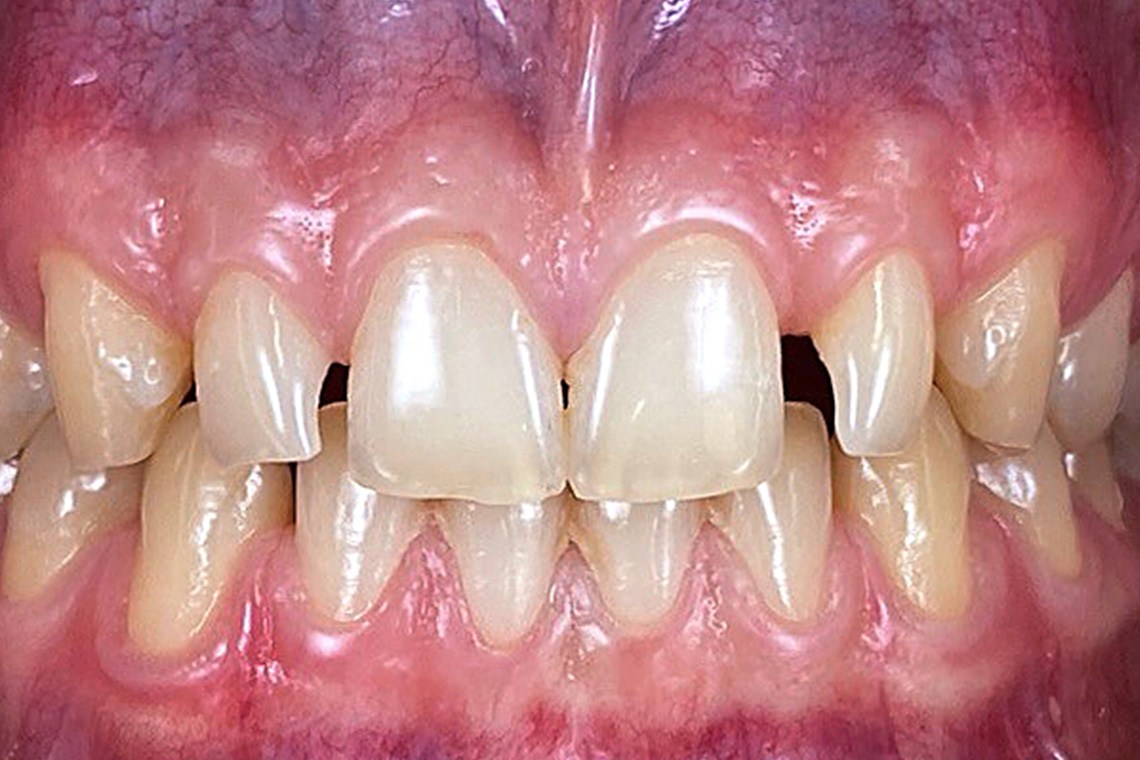 The initial situation with multiple diastemata and rotated second incisors with microdontia in the upper jaw.