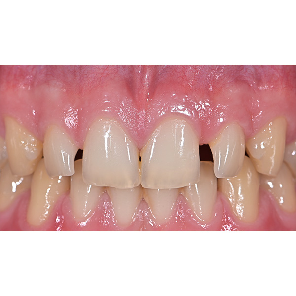 The initial situation with multiple diastemata and rotated second incisors with microdontia in the upper jaw.