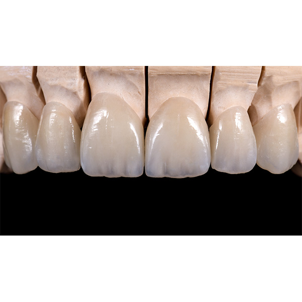 Even on the model the veneer restorations looked absolutely natural.