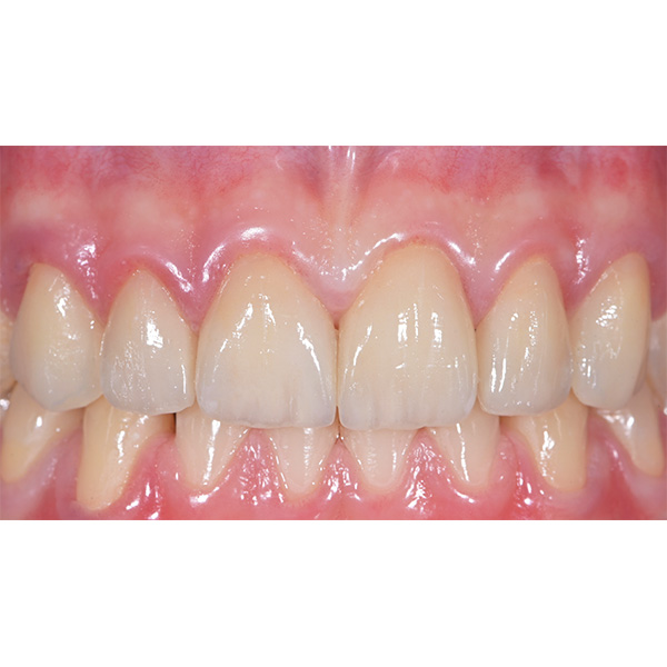 Final treatment result after full-adhesive cementation of the highly esthetic veneers.
