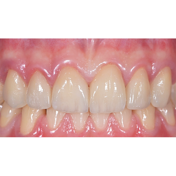 El resultado final del tratamiento tras la fijación completamente adhesiva de las carillas altamente estéticas.