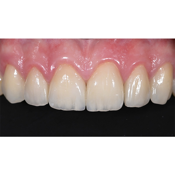 The veneers made of VITA AMBRIA showed a natural play of light and color.
