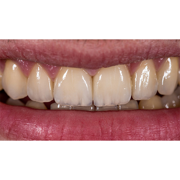 The smile line harmonized with the incisal edges of the veneer restorations.
