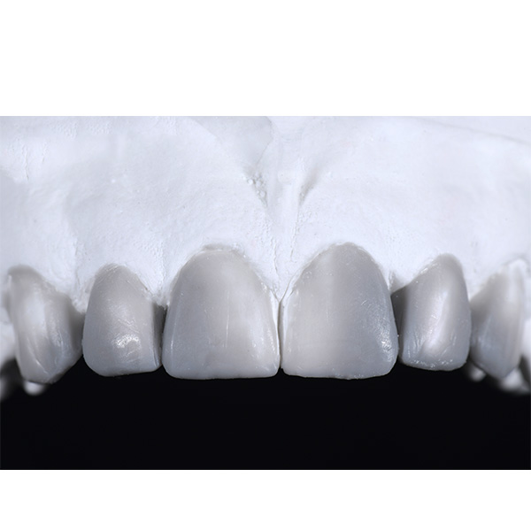 An esthetic wax-up with an ideal esthetic morphology was created on the upper diagnostic model.
