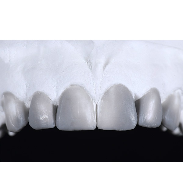 Ein Wax-up mit idealer ästhetischer Morphologie wurde auf dem diagnostischen Oberkiefermodell angefertigt.