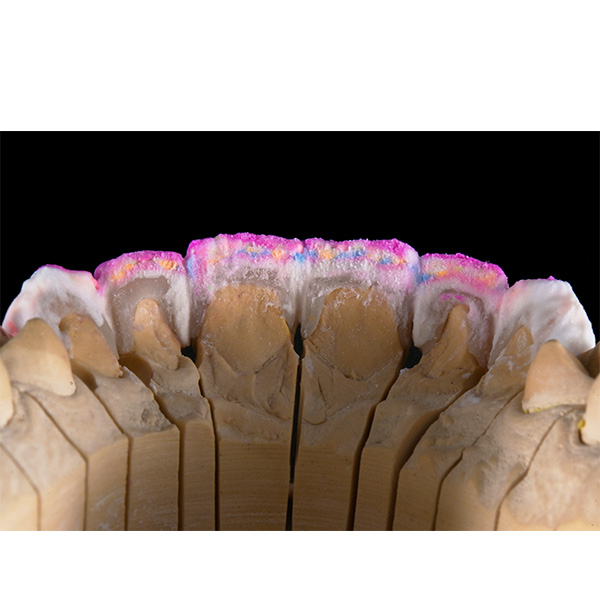 The meticulous layering procedure from the palatal view.