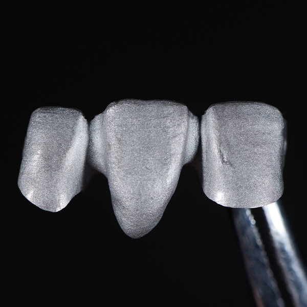 Titanium framework for a patient restoration in the esthetic zone.