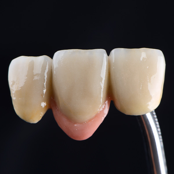 The completed restoration before seating in the patient's mouth.