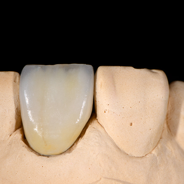 The highly esthetic veneer with the universal veneering ceramic VITA LUMEX AC.