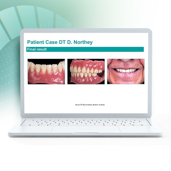 Laptop showing extract of the webinar "Digital dentures for beginners”