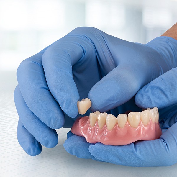 Ein präfabrizierter Zahn wird in eine digital hergestellte Prothesenbasis geklebt
