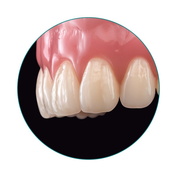 VITA VIONIC VIGO tooth in a denture