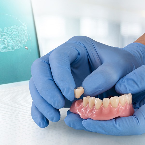 Ein VITA VIONIC VIGO Zahn wird in eine digital hergestellte Prothesenbasis geklebt