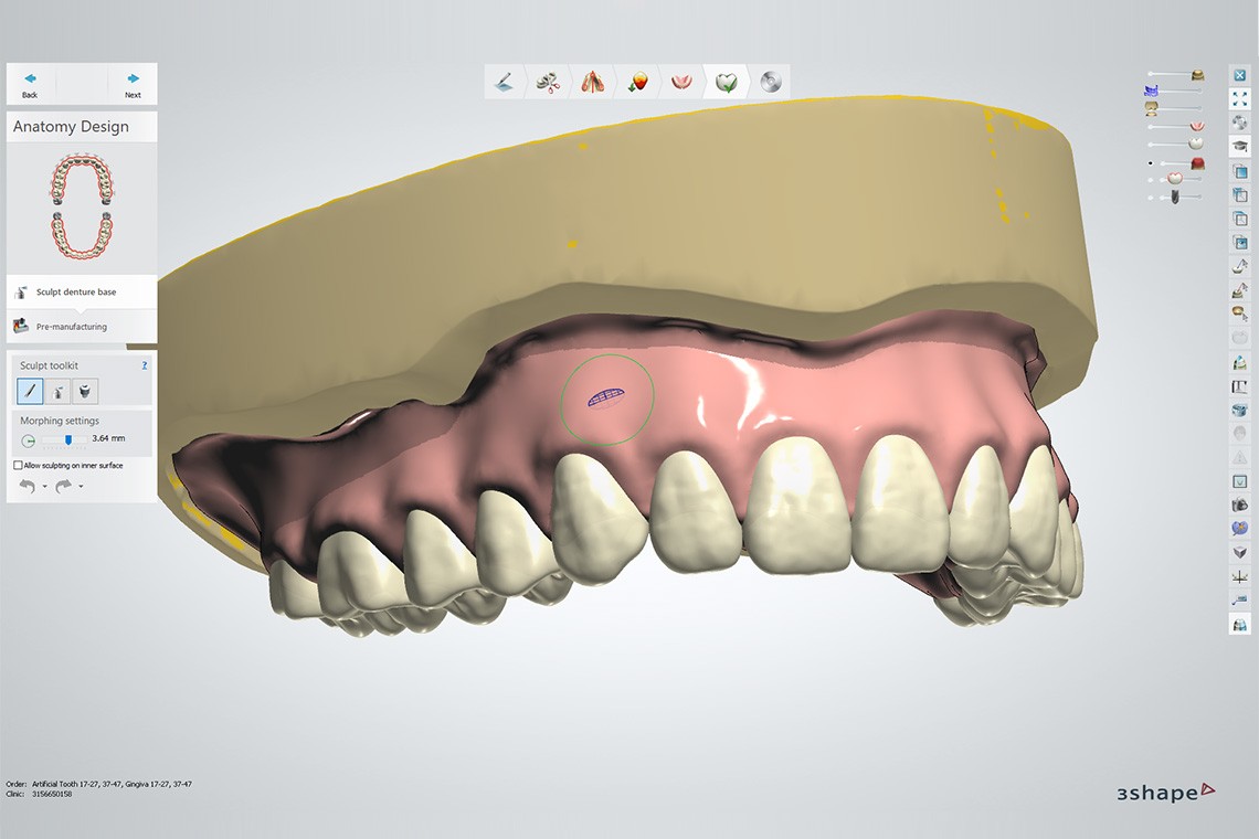 Vier Screenshots der 3Shape-Software mit einigen der vielen  Aufstellungen aus der VITA Bibliothek