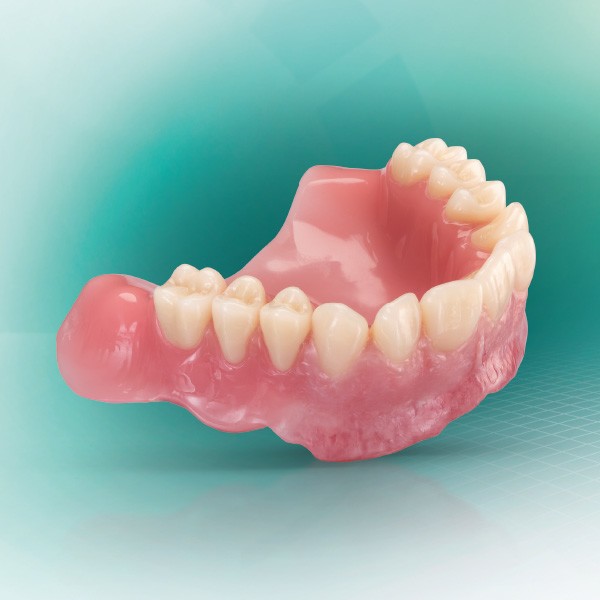 A digitally fabricated upper denture made of VITA VIONIC system components