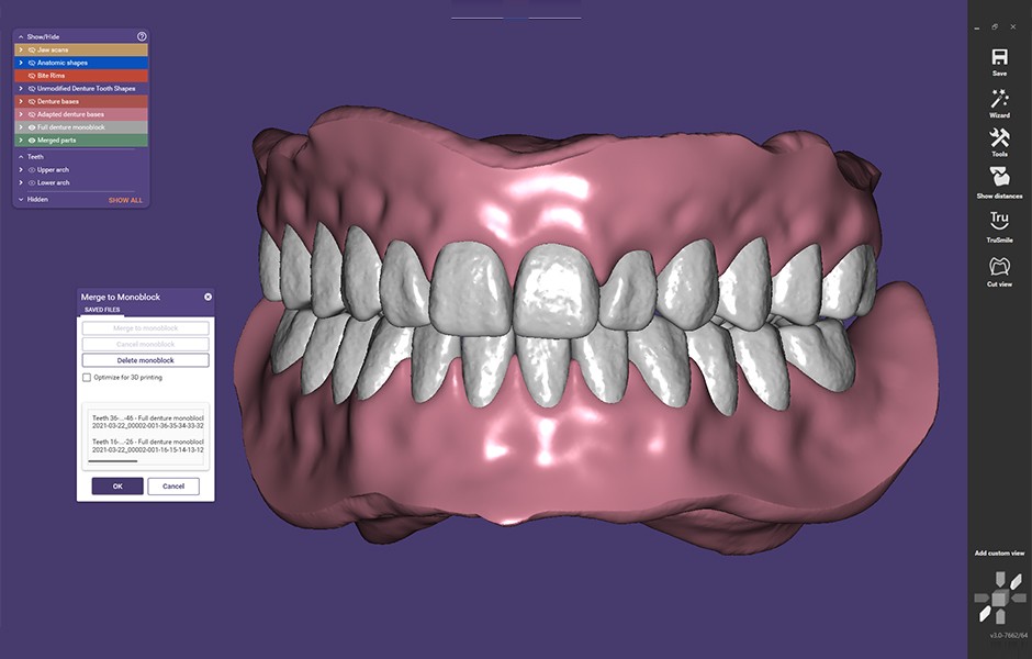 Vue d'écran d'une prothèse dentaire dans le système CAO