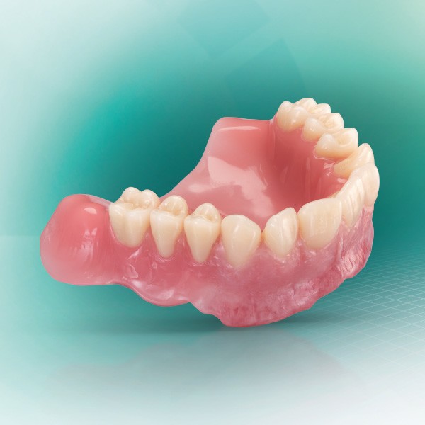 Une prothèse maxillaire fabriquée de manière numérique à partir de composants du système VITA VIONIC