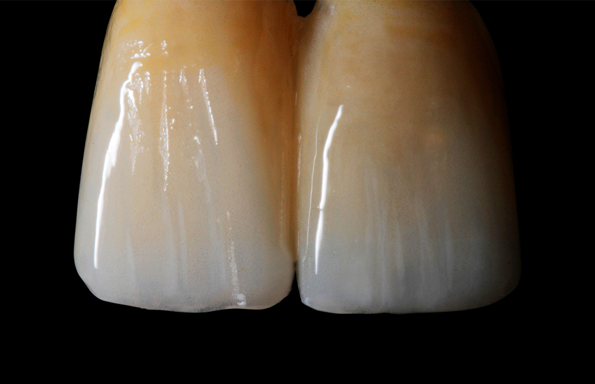 The long-term temporary restoration after characterization with the composite stains VITA AKZENT LC.