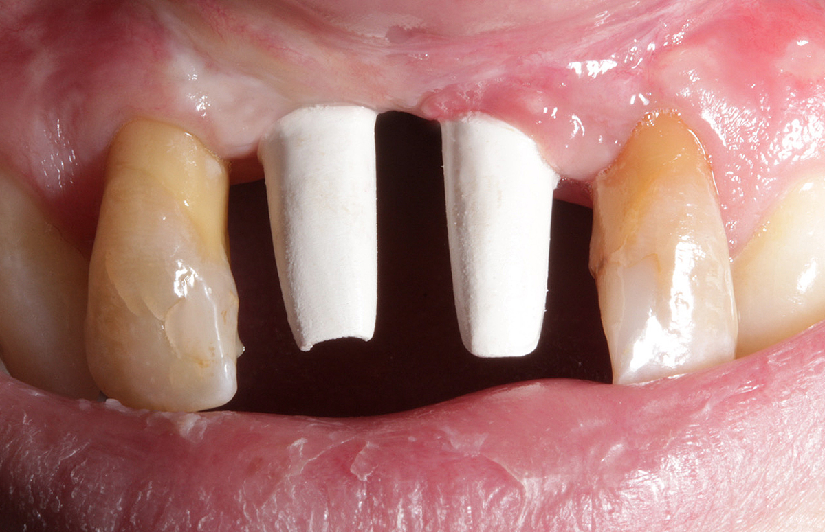 The screwed-on abutments made of PEEK in the patient's mouth.