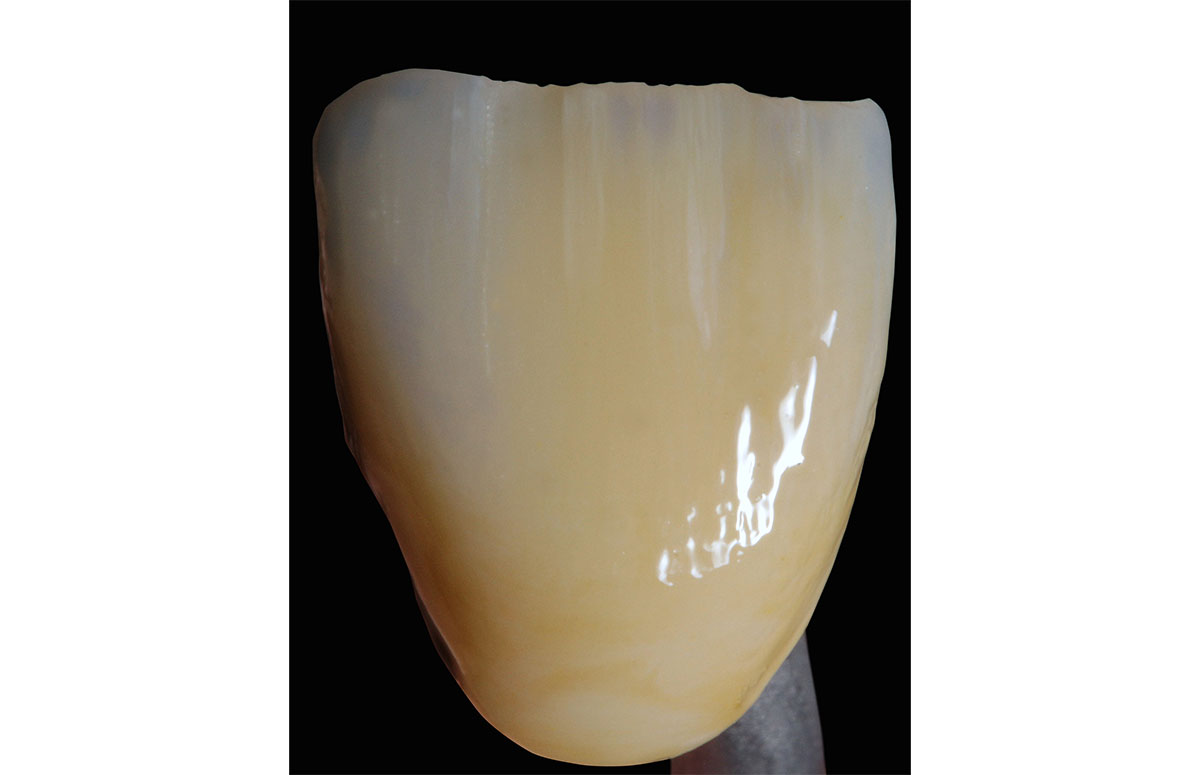 The integrated long-term temporary restoration made of the composite material VITA CAD-Temp monoColor.
