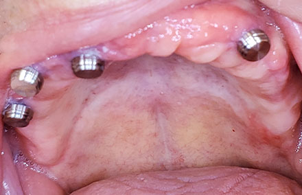 El maxilar superior tras la inserción de los cuatro implantes.