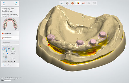 The virtual model during the analysis and block out phase.