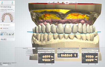 The virtual setup with the selection of tooth shapes.