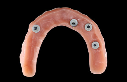 Basal view of the denture with the integrated matrices.