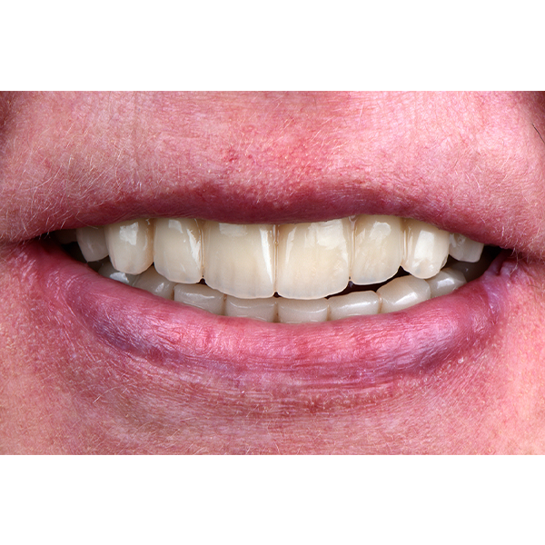 VITA VIONIC DENT DISC multiColor offre le stesse caratteristiche di estetica e funzionalità dei denti premium VITA.