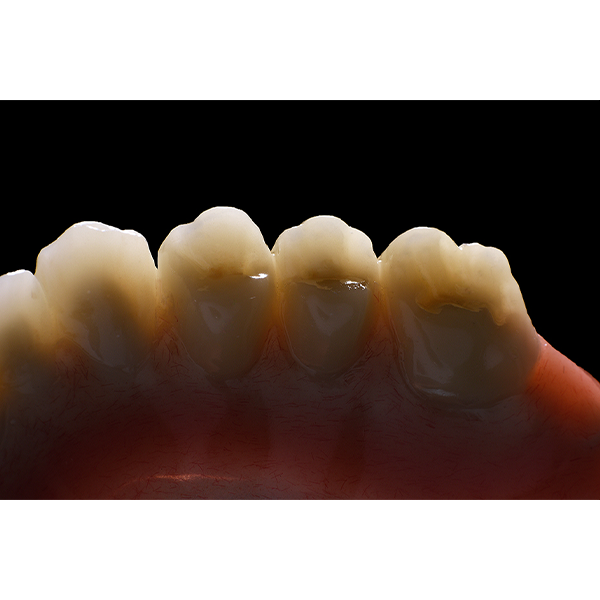 Vue macroscopique des dents postérieures avec une translucidité naturelle et un dégradé de couleurs.